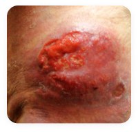 mycosis fungoides (MF) tumor